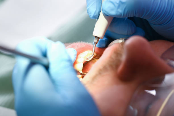 Best Emergency Dental Care for Broken or Chipped Teeth in Vernon Valley, NJ